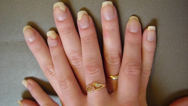 Traitez Votre Mycose Des Ongles Avec Des Huiles Essentielles